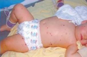 В Бресте от менингококковой инфекции умерла двухмесячная девочка