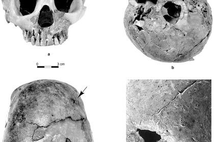 Ученые обнаружили следы древнейшей черепно-мозговой травмы